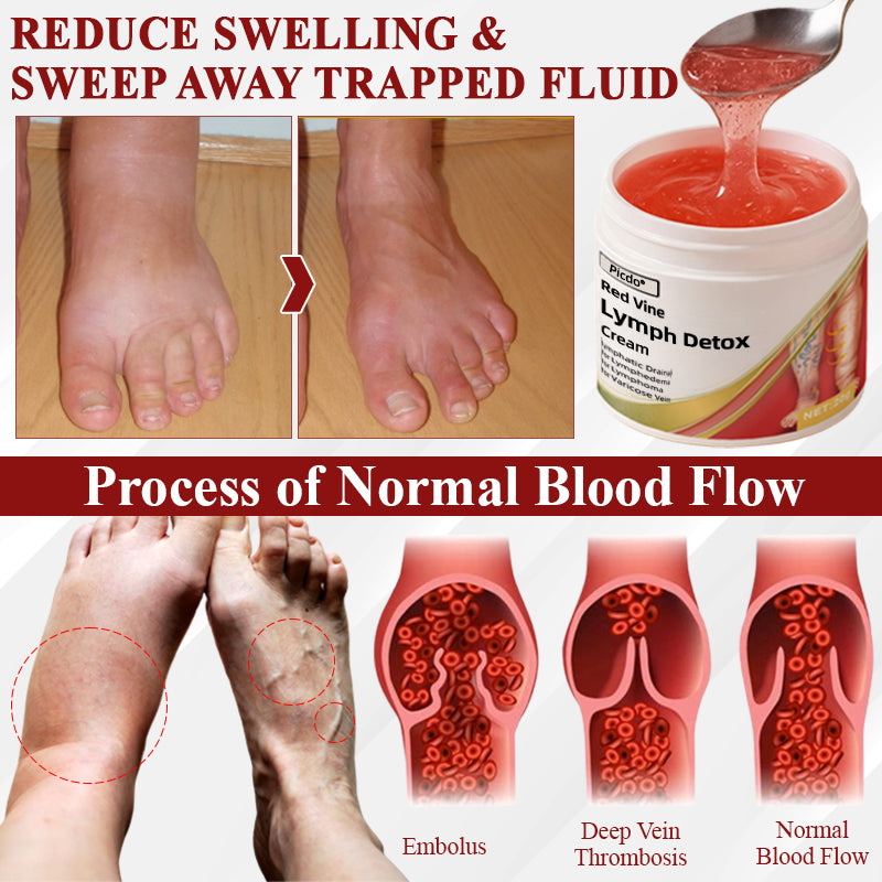 Picdo® Red Vine Lymph Detox Cream👩⚕️Indicated for lymphedema, lymphoma, lymphadenopathy, lymphatic malformations, and varicose veins🌱