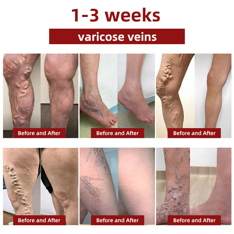 Picdo® Red Vine Lymph Detox Cream👩⚕️Indicated for lymphedema, lymphoma, lymphadenopathy, lymphatic malformations, and varicose veins🌱