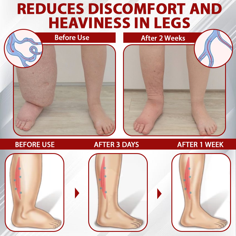 Picdo® Red Vine Lymph Detox Cream👩⚕️Indicated for lymphedema, lymphoma, lymphadenopathy, lymphatic malformations, and varicose veins🌱