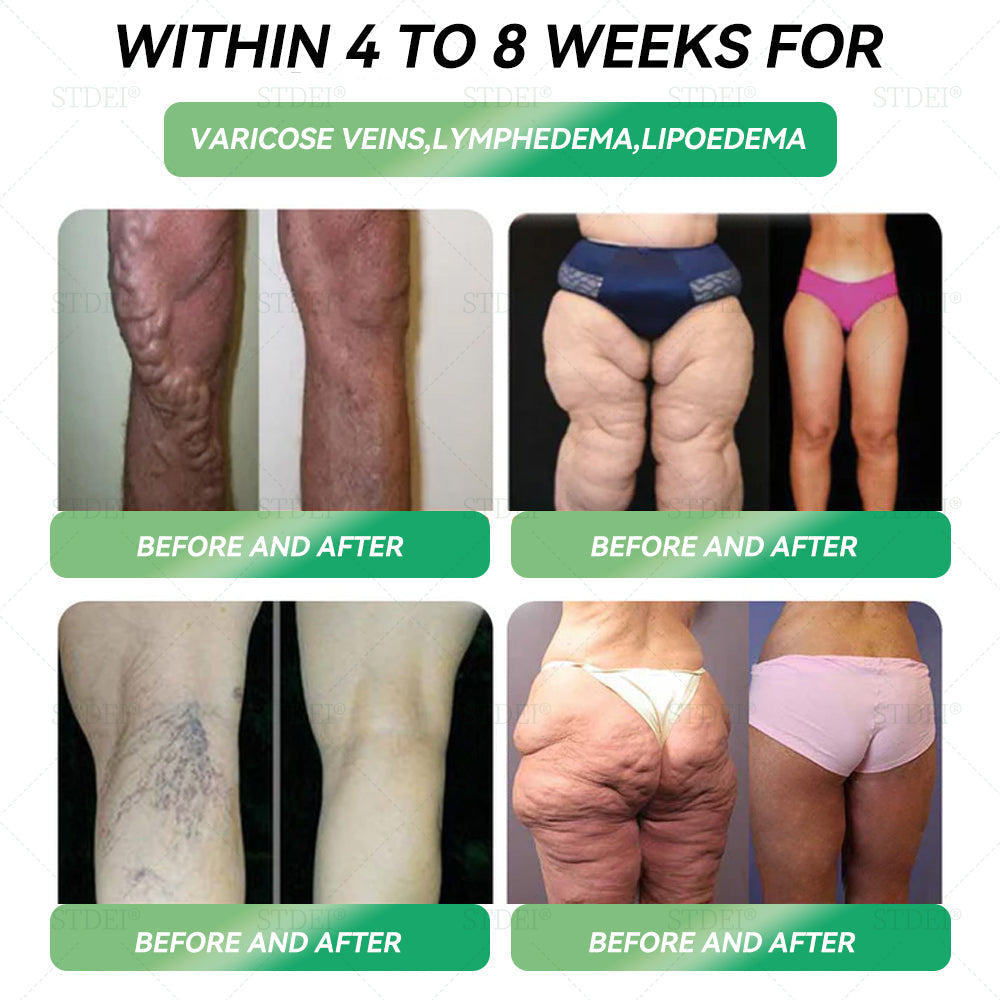 Recommended by leading U.S. Clinics | Official Store | ๐บ๐ป๐ซ๐ธ๐ผยฎ ๐ฎ๐ณ๐ท-1 ๐๐๐๐ ๐๐๐๐ข๐ก๐๐๐ ๐ฑ Just once a week, visible results in 7 days (Targets ๐๐๐๐ ๐๐ก๐ฆ, ๐๐ฆ๐๐โ๐๐๐๐๐, ๐๐๐๐๐๐ก๐๐ , ๐๐๐ โ๐๐๐๐ก-๐๐๐๐๐ก๐๐ ๐๐๐๐๐๐ก๐๐๐๐ ) ๐น