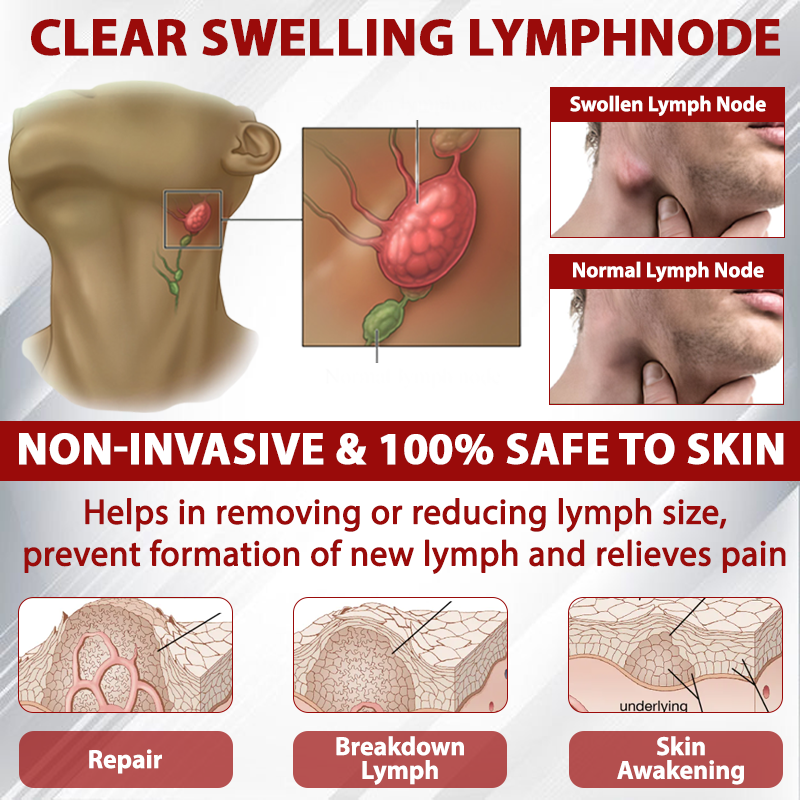 Picdo® Red Vine Lymph Detox Cream👩⚕️Indicated for lymphedema, lymphoma, lymphadenopathy, lymphatic malformations, and varicose veins🌱