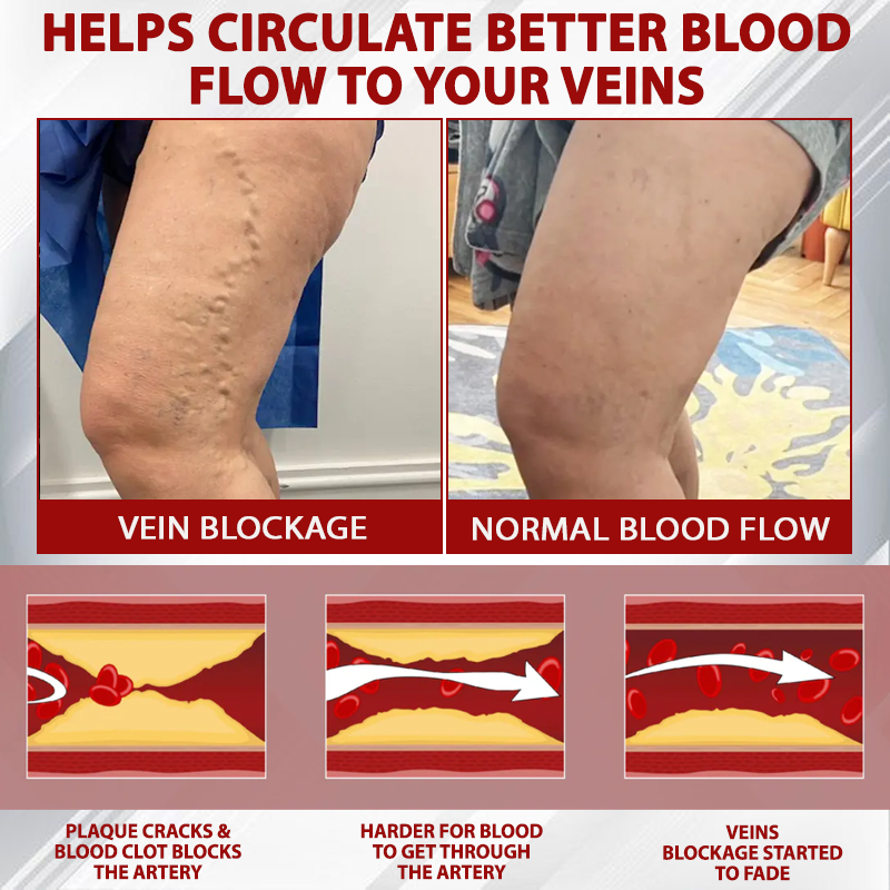 Picdo® Red Vine Lymph Detox Cream👩⚕️Indicated for lymphedema, lymphoma, lymphadenopathy, lymphatic malformations, and varicose veins🌱