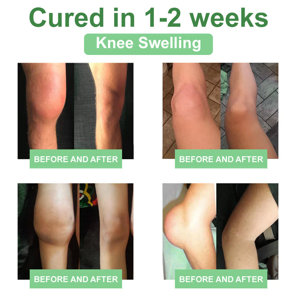 Picdo® Chillflex Fast-Acting Joint Pain Cream🌱For the treatment of |Arthritis|Joint deformities|Rheumatism|Sports injuries|Muscle injuries