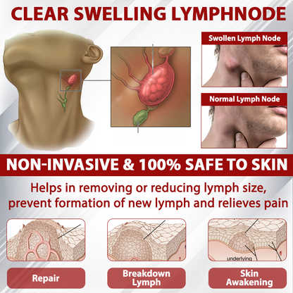 Picdo® Red Vine Lymph Detox Cream👩‍⚕️Indicated for lymphedema, lymphoma, lymphadenopathy, lymphatic malformations, and varicose veins🌱